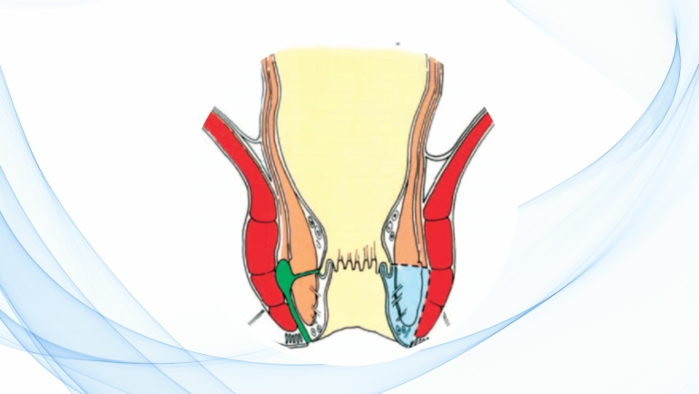 blog-fistulotomia-y-fistulectomia