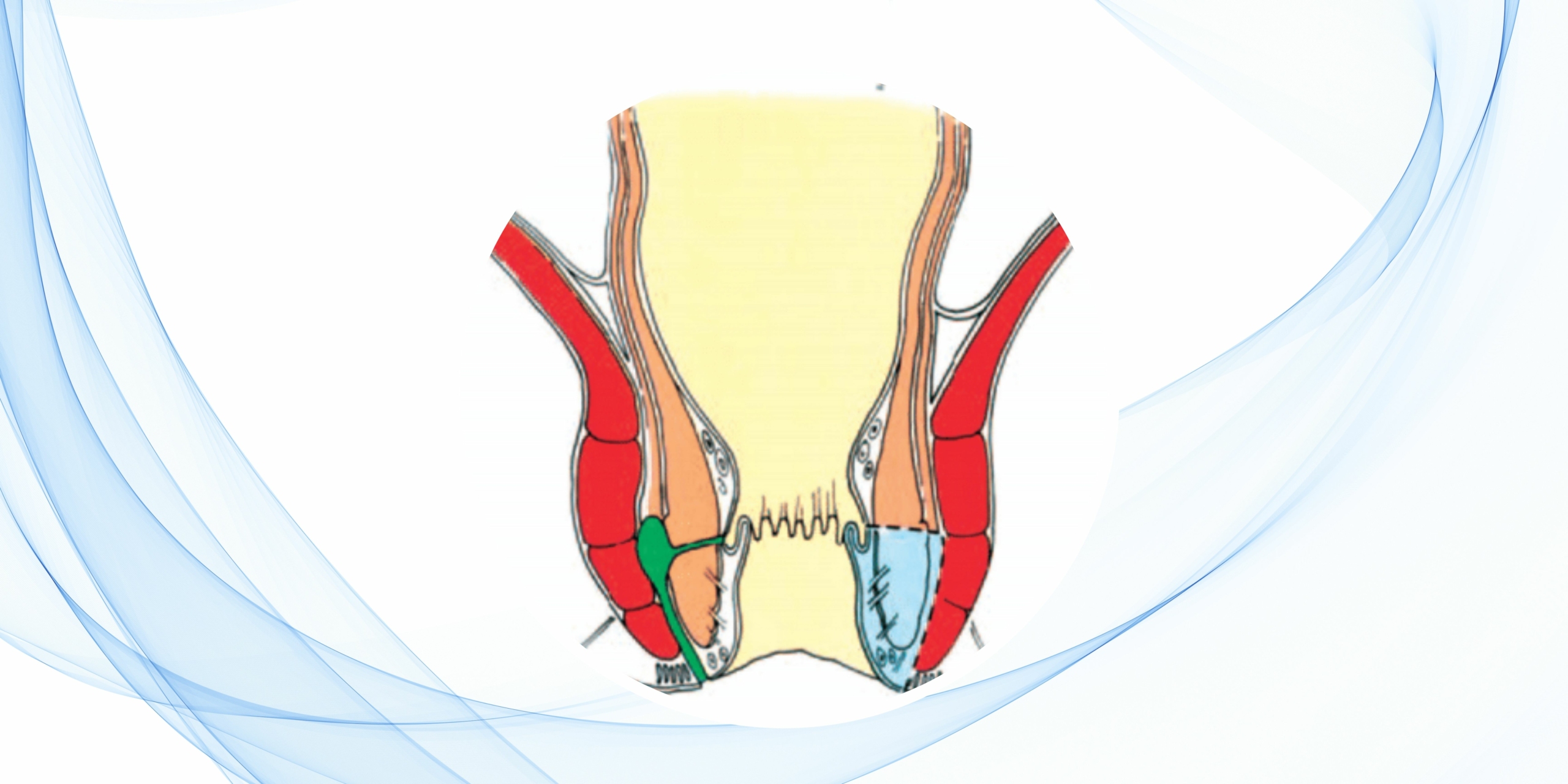 blog-fistulotomia-y-fistulectomia