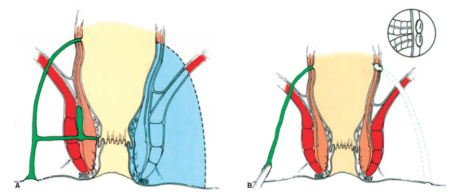 fistulectomia