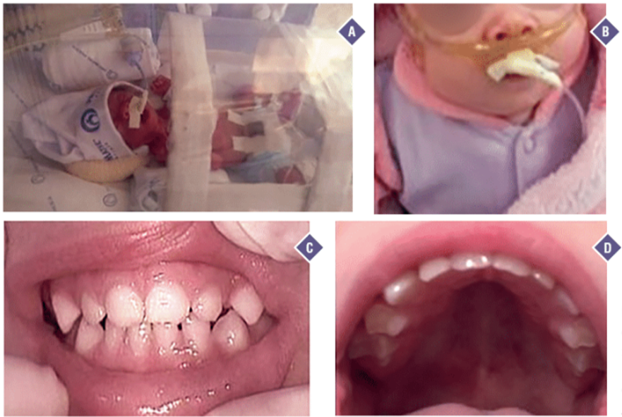 atencion-odontologica-prenatal-prematuros