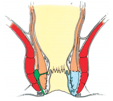 fistulotomia