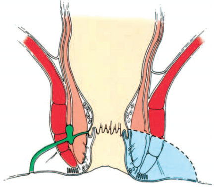 fistulotomia