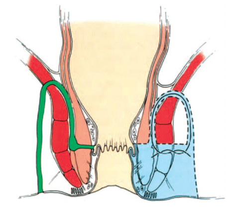 fistulotomia